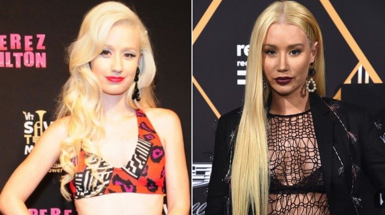 Iggy Azalea avant et après chirurgie plastique