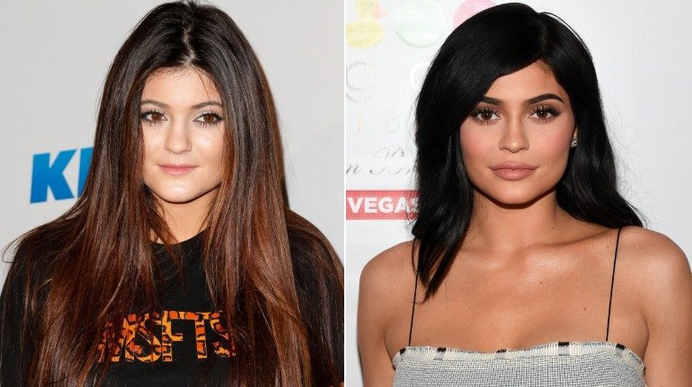 Kylie Jenner avant et après les lèvres