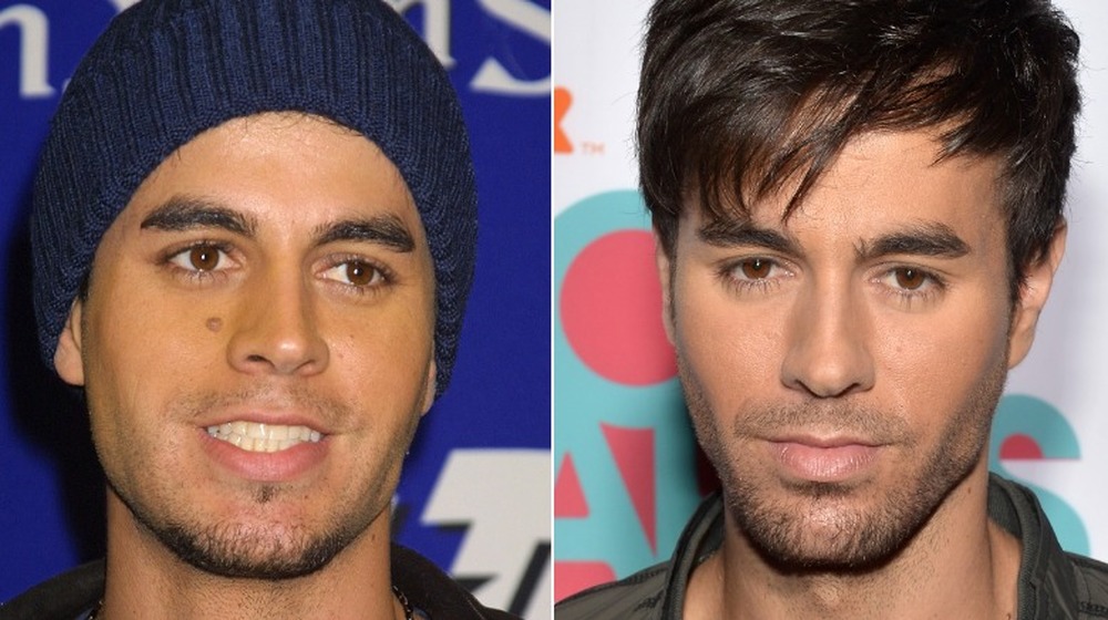 Enrique Iglesias avec taupe sur le visage; Enrique Iglesias après la chirurgie