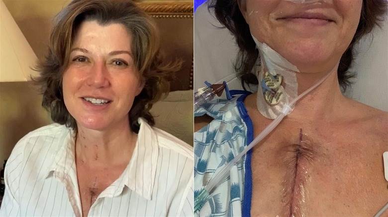 Amy Grant montrant une cicatrice de chirurgie cardiaque